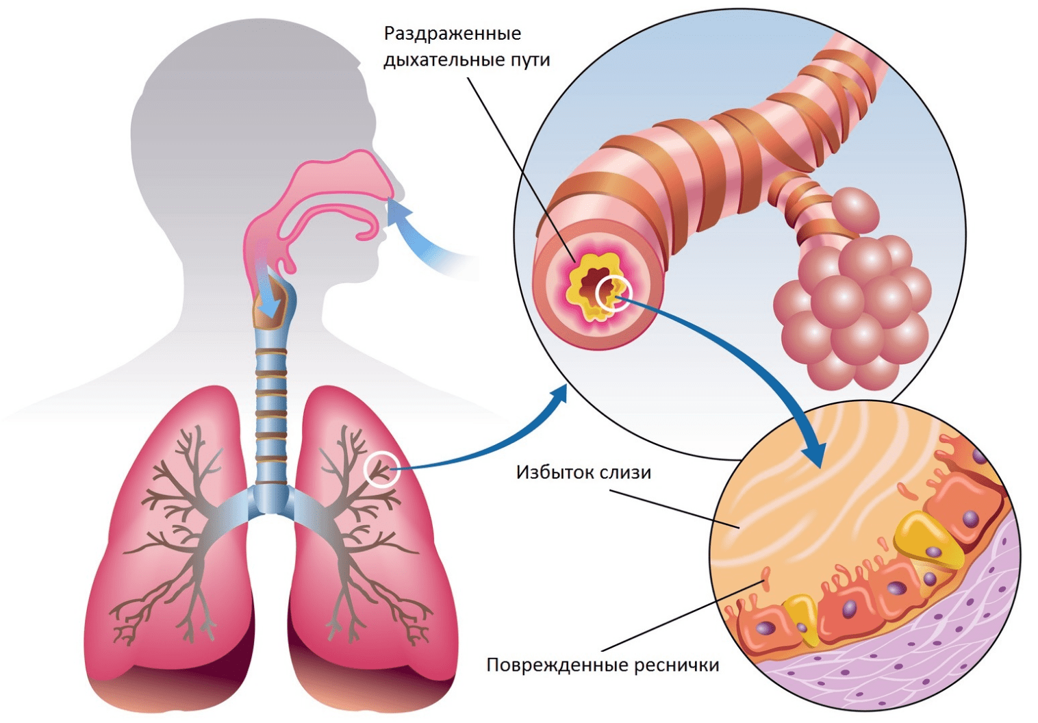 Bronquitis