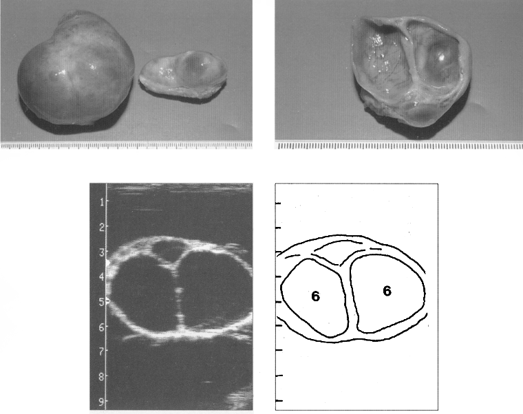 Kystes de l'ovaire