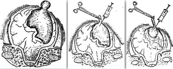 juh coenurosis kezelése